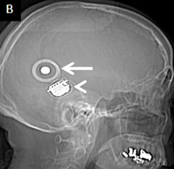 Radiological image of the head with arrow pointing to implant